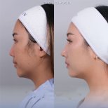 Facial feminization surgery before and after result at Dr. Chen Surgery Hospital International Center