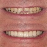 Результаты до и после бондинга зубов в Atelier Uśmiechu, улучшение эстетики улыбки