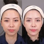 Facial feminization surgery before and after result at Dr. Chen Surgery Hospital International Center