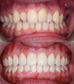 Before and after Invisalign results at Atelier Uśmiechu, teeth alignment improvement
