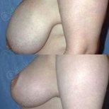 Before and after breast lift results at CE International Hospital, improved breast contour