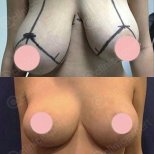 Before and after breast lift results at CE International Hospital, improved breast contour