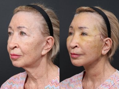 Результаты до и после deep plane SMAS лифтинга в RNWOOD Plastic Surgery, омоложение лица