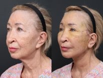 Результаты до и после deep plane SMAS лифтинга в RNWOOD Plastic Surgery, омоложение лица