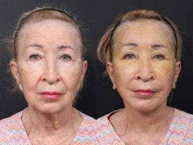 Результаты до и после Deep Plane Facelift в RNWOOD Plastic Surgery, омоложение лица