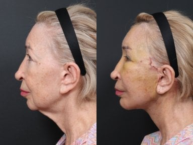 Результаты до и после deep plane SMAS лифтинга в RNWOOD Plastic Surgery, омоложение лица