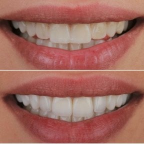 Vorher-nachher-Veneers bei ÜMRAN TIP MERKEZİ – weißeres, ebenmäßiges Lächeln