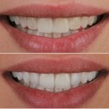 Vorher-nachher-Veneers bei ÜMRAN TIP MERKEZİ – weißeres, ebenmäßiges Lächeln