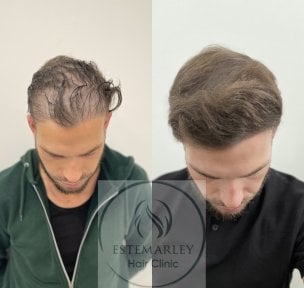 Vorher-nachher-Ergebnis DHI-Haartransplantation bei Estemarley – wiederhergestellte Haardichte