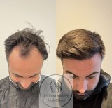 Vorher-nachher-Ergebnis DHI-Haartransplantation bei Estemarley – Haarlinie wiederhergestellt