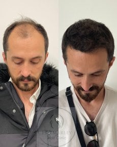 Vorher-nachher-Ergebnisse DHI-Haartransplantation bei Estemarley – Haarlinie wiederhergestellt