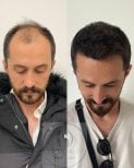 Vorher-nachher-Ergebnisse DHI-Haartransplantation bei Estemarley – Haarlinie wiederhergestellt