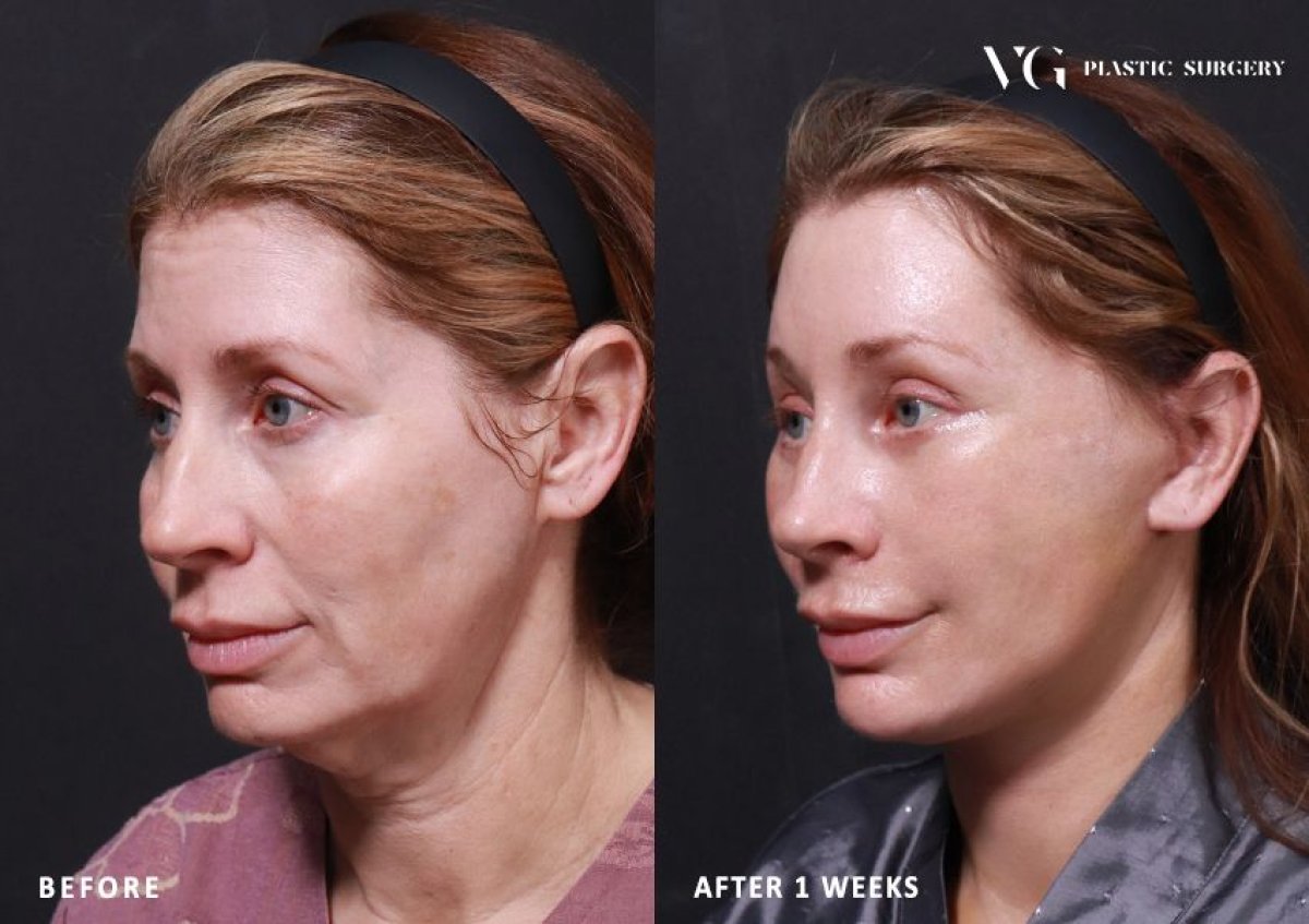 Facelift Vorher-Nachher-Ergebnis bei VG Plastic Surgery – sichtbare Verjüngung nach 1 Woche