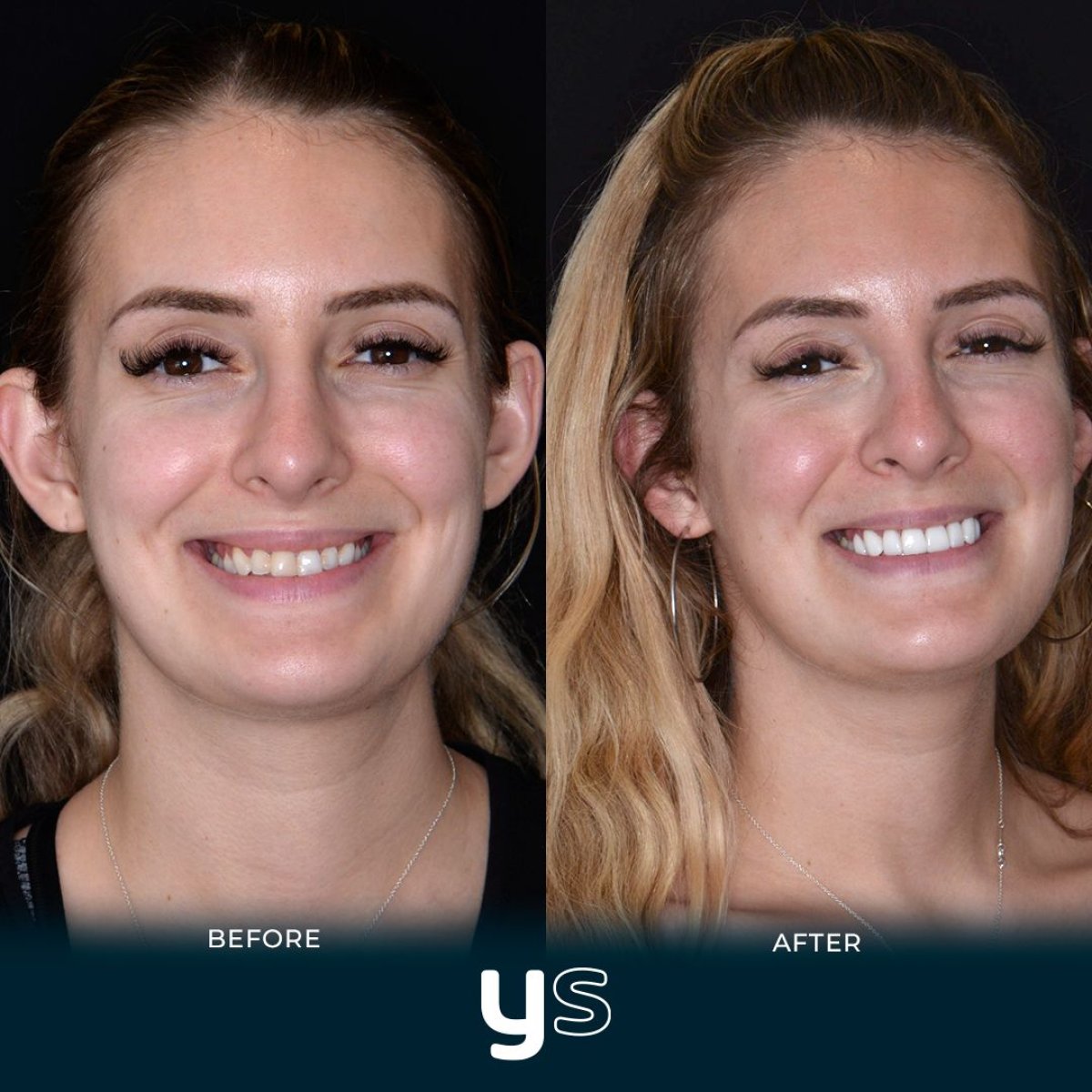Resultados de antes y después de bonding dental en YeahSmile, mejora visible de la sonrisa