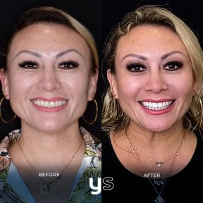 Before and after dental bonding results at YeahSmile, improved smile aesthetics and whiter teeth
