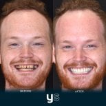 Before and after dental bonding results at YeahSmile – improved smile and whiter teeth