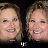 Before and after dental bonding results at YeahSmile – improved smile and restored teeth