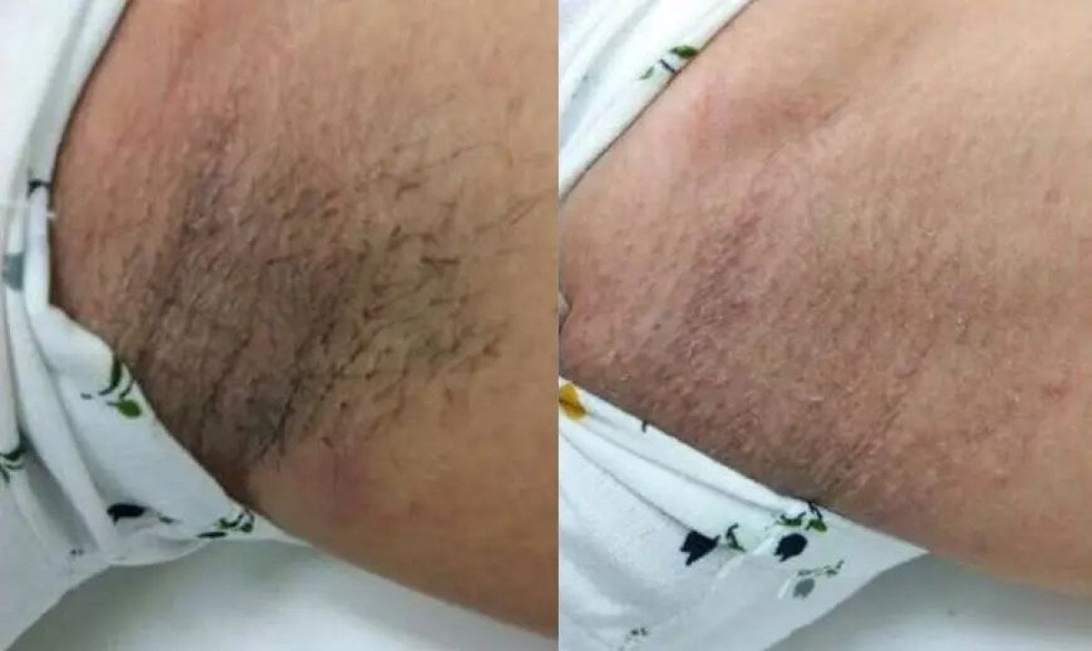 نتائج إزالة الشعر بالليزر تحت الإبط قبل وبعد في مستشفى وانسيري، بشرة أكثر نعومة