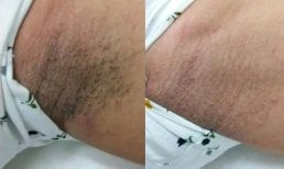 Before and after laser hair removal results at Wansiri Hospital, smoother underarm skin