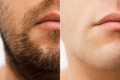 Before and after laser hair removal results on male face at Wansiri Hospital, smooth skin