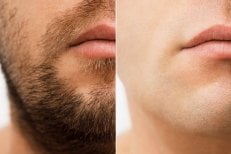 Before and after laser hair removal results on male face at Wansiri Hospital, smooth skin