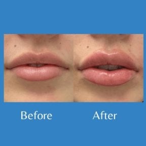 Before and after lipofilling at ID Clinic Bangkok, fuller lips after fat grafting result