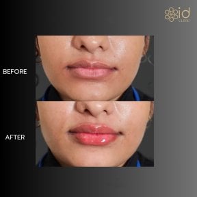 Before and after lipofilling at ID Clinic Bangkok, fuller lips after fat grafting result