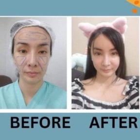 Before and after lipofilling results at ID Clinic Bangkok, facial fat grafting for volume enhancement