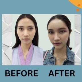 Before and after lipofilling results at ID Clinic Bangkok, enhanced facial volume and contour