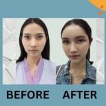 Before and after lipofilling results at ID Clinic Bangkok, enhanced facial volume and contour