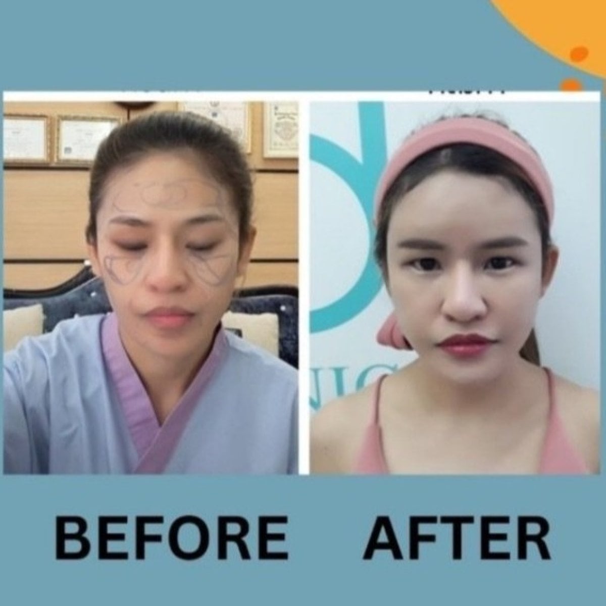 Resultados de lipofilling facial antes y después en ID Clinic Bangkok, mejora visible