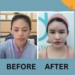 Before and after lipofilling results at ID Clinic Bangkok, facial fat grafting improvement
