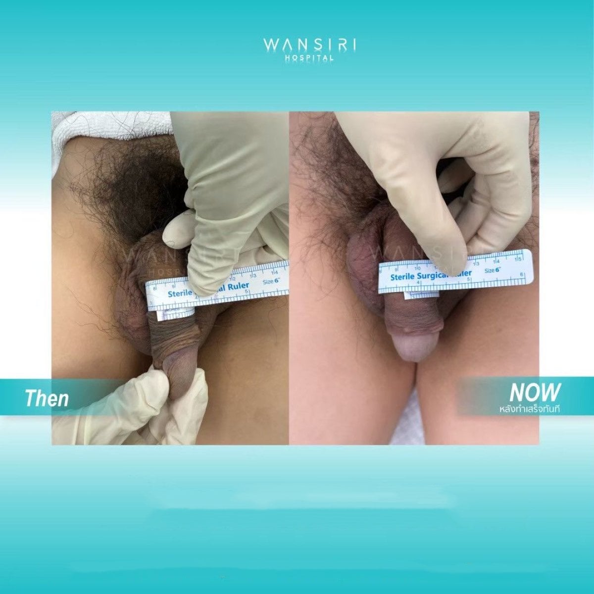 Resultados de alargamiento de pene antes y después en Wansiri Hospital, aumento visible