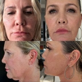 Deep plane facelift before and after results at Marroquín & Sandoval Plastic Surgery Clinic