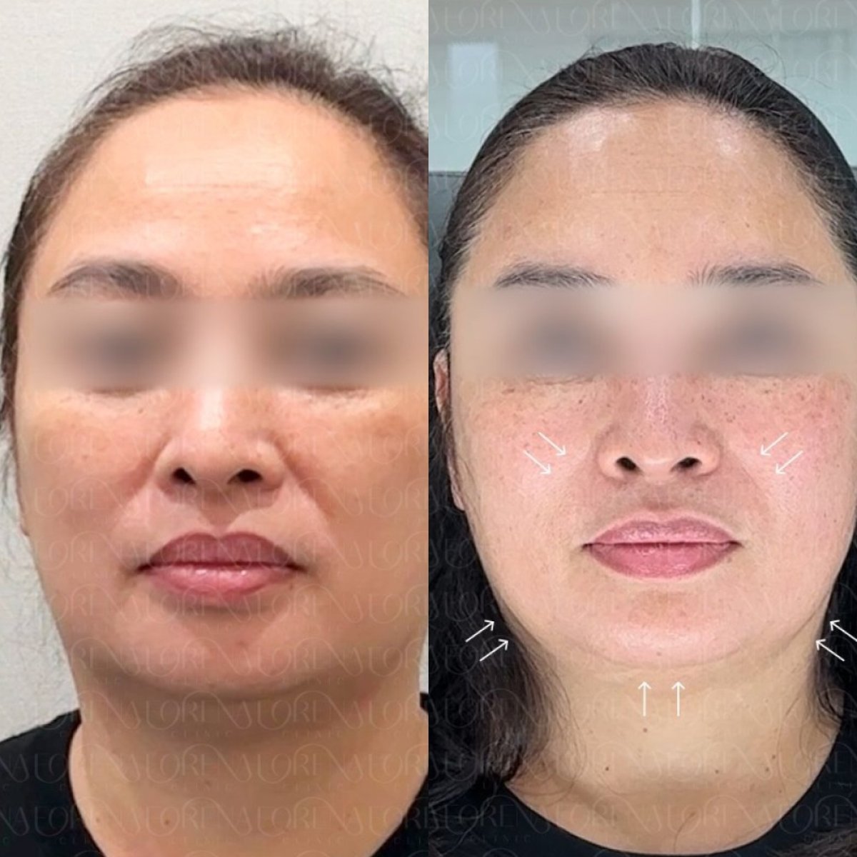 نتائج قبل وبعد علاج Ultherapy في عيادة Forena – شد ورفع واضح للبشرة