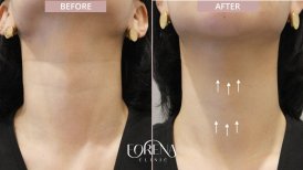 Результаты до и после омоложения шеи филлерами гиалуроновой кислоты в Forena Clinic