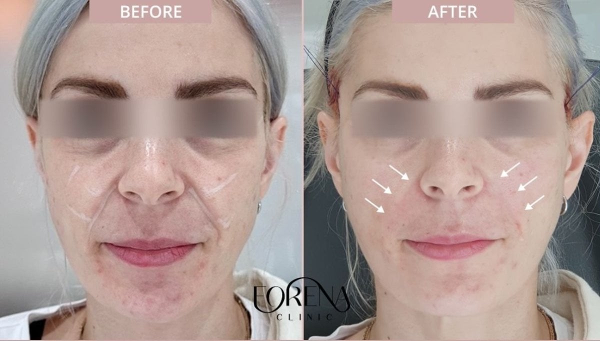 Resultados de lifting con hilos antes y después en Forena Clinic, mejora de la piel facial