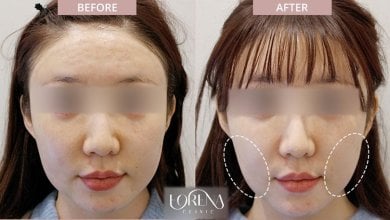 Ultherapy before and after results at Forena Clinic – visible facial contour improvement