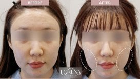 Ultherapy before and after results at Forena Clinic – visible facial contour improvement