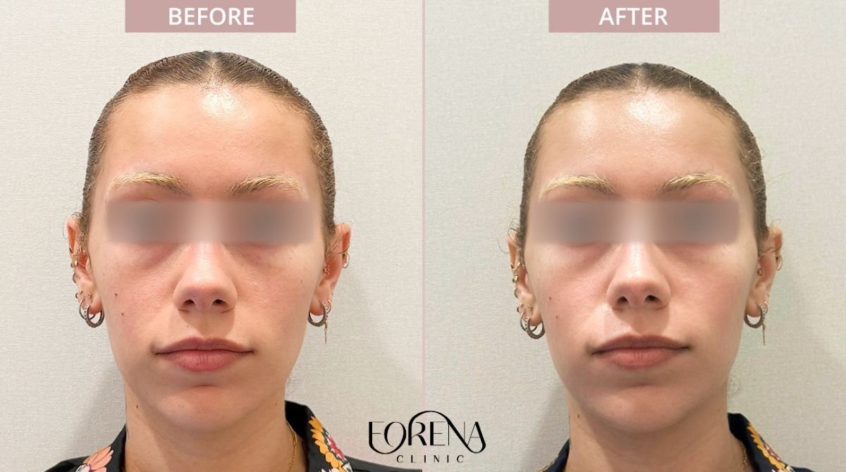 Результати омолодження шкіри до і після у Forena Clinic, покращення текстури обличчя