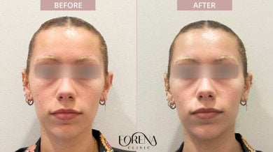 Результаты омоложения кожи до и после в Forena Clinic, улучшение текстуры лица