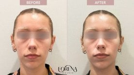 Результаты омоложения кожи до и после в Forena Clinic, улучшение текстуры лица