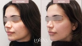 Результаты омоложения кожи до и после в Forena Clinic, улучшение текстуры лица