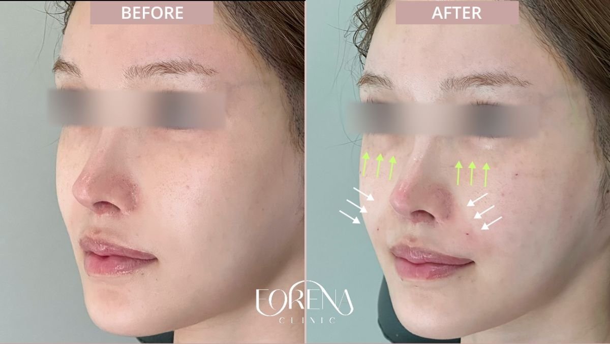 Antes y después de rellenos en Forena Clinic, mayor volumen de mejillas y contorno facial