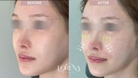 Before and after fillers injection at Forena Clinic, enhanced cheek volume and facial contour result