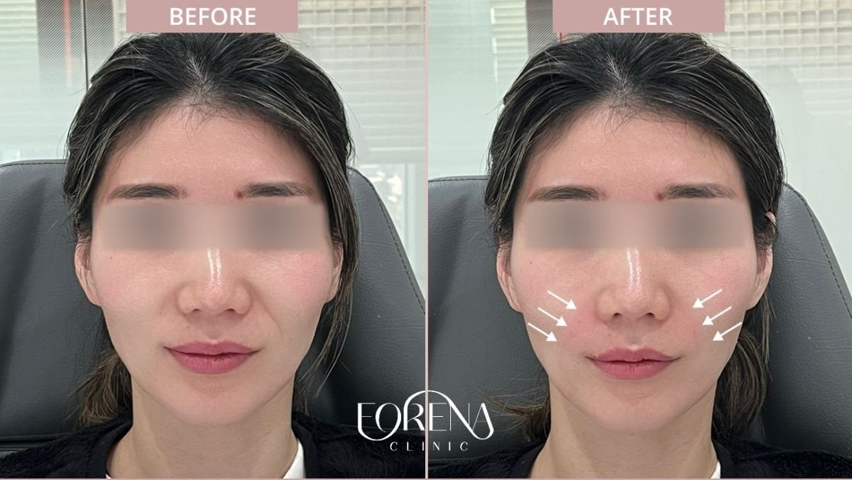 Antes y después de rellenos en Forena Clinic, mayor volumen de mejillas y contorno facial