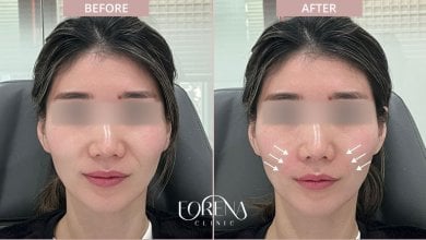 Before and after fillers injection at Forena Clinic, enhanced cheek volume and facial contour result