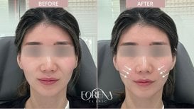 Before and after fillers injection at Forena Clinic, enhanced cheek volume and facial contour result