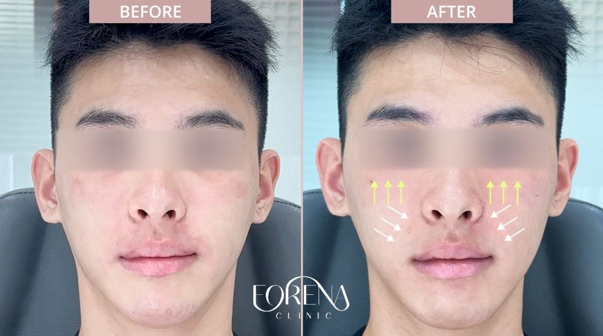 Antes y después de inyecciones de relleno en Forena Clinic, mejillas y contorno facial mejorados