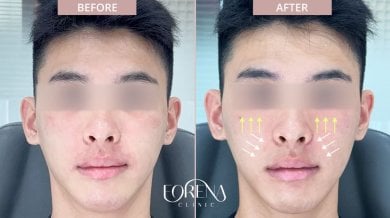 Before and after fillers injection at Forena Clinic, enhanced cheek volume and facial contour result